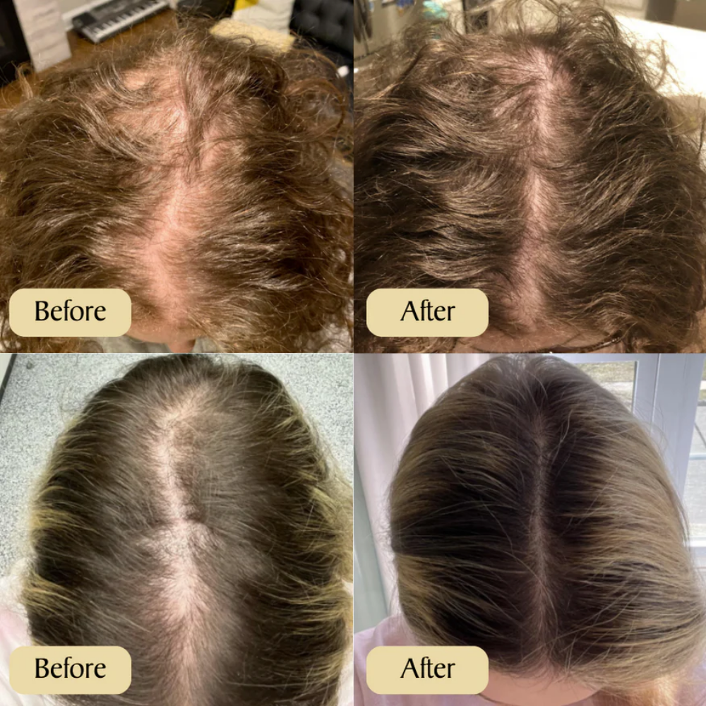 Shekys Micro-Infusion Hair Regrowth System