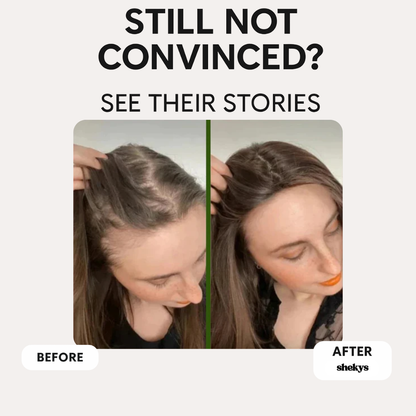 Shekys Micro-Infusion Hair Regrowth System